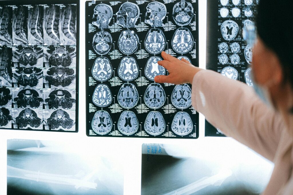 TBI Traumatic Brain Injury after a texas motorcycle wreck