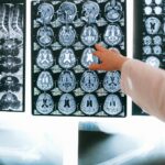 TBI Traumatic Brain Injury after a texas motorcycle wreck